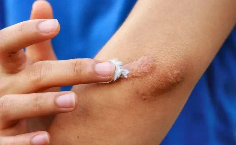 Cara Menghilangkan Bekas Luka Alami: Rahasia Kulit Mulus Bebas Noda dengan Bahan Herbal