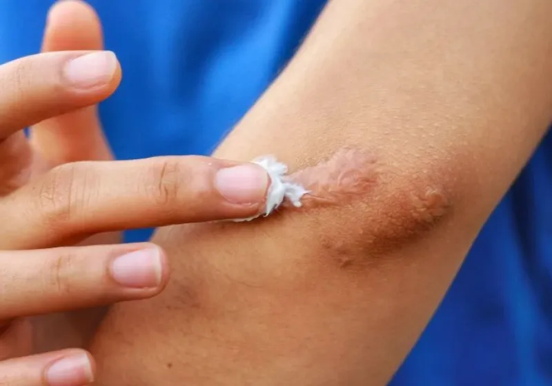 Cara Menghilangkan Bekas Luka Alami: Rahasia Kulit Mulus Bebas Noda dengan Bahan Herbal